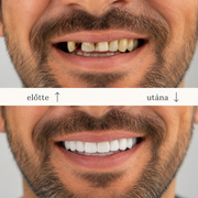 SMILEFIT PRO – ÁLLÍTHATÓ FOGPÓTLÁS KÉSZLET A TÖKÉLETES MOSOLYÉRT